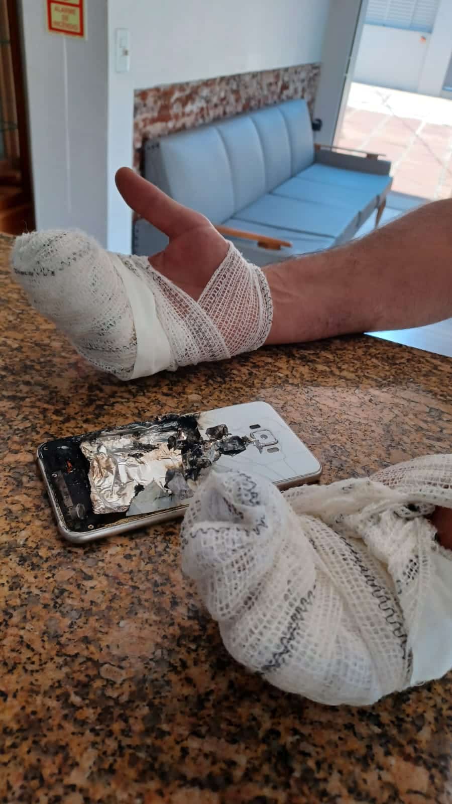 Celular explode no bolso de um homem; ele sofreu queimaduras nas mãos